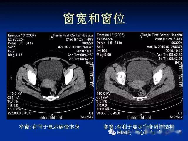 女性生殖系統正常解剖及表現