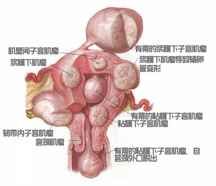 宫腔的位置关系,分为三型:凸向粘膜下,肌壁间(2