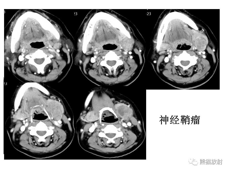 省立影像讀片腮腺病變2012