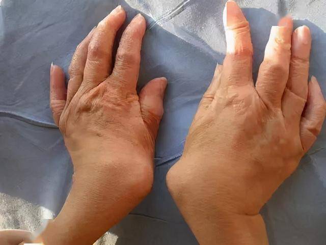 皮疹,红斑,水肿,溃疡…风湿病人的皮肤该如何护理?