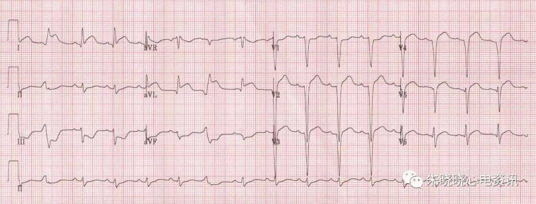 心肌缺血的心电图表现