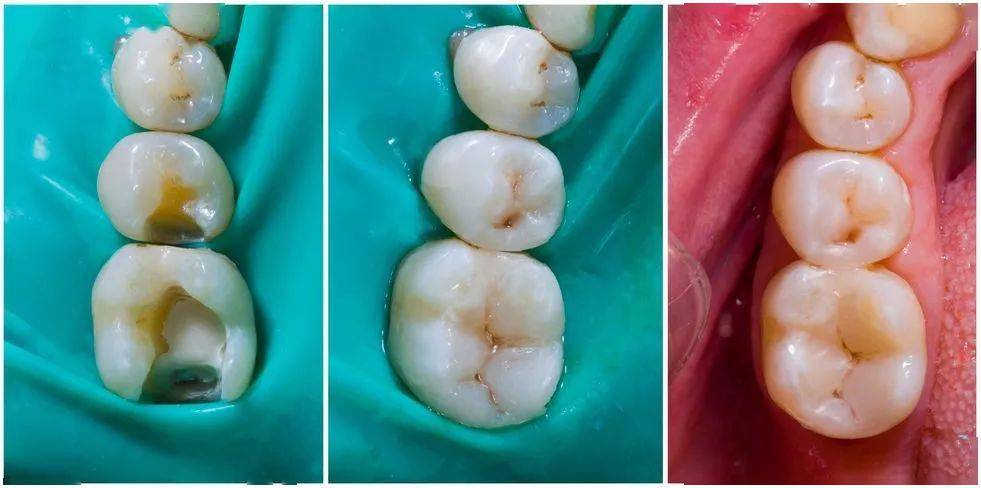 浅龋中龋补牙就可以了深龋牙髓炎要怎么办