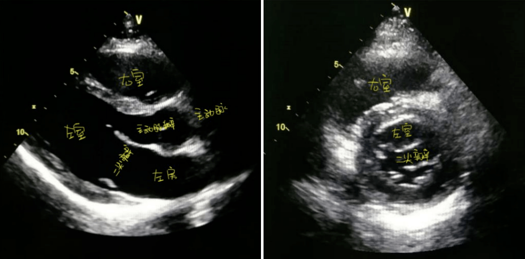 二尖瓣:正常瓣口面积 4～6 cm05.