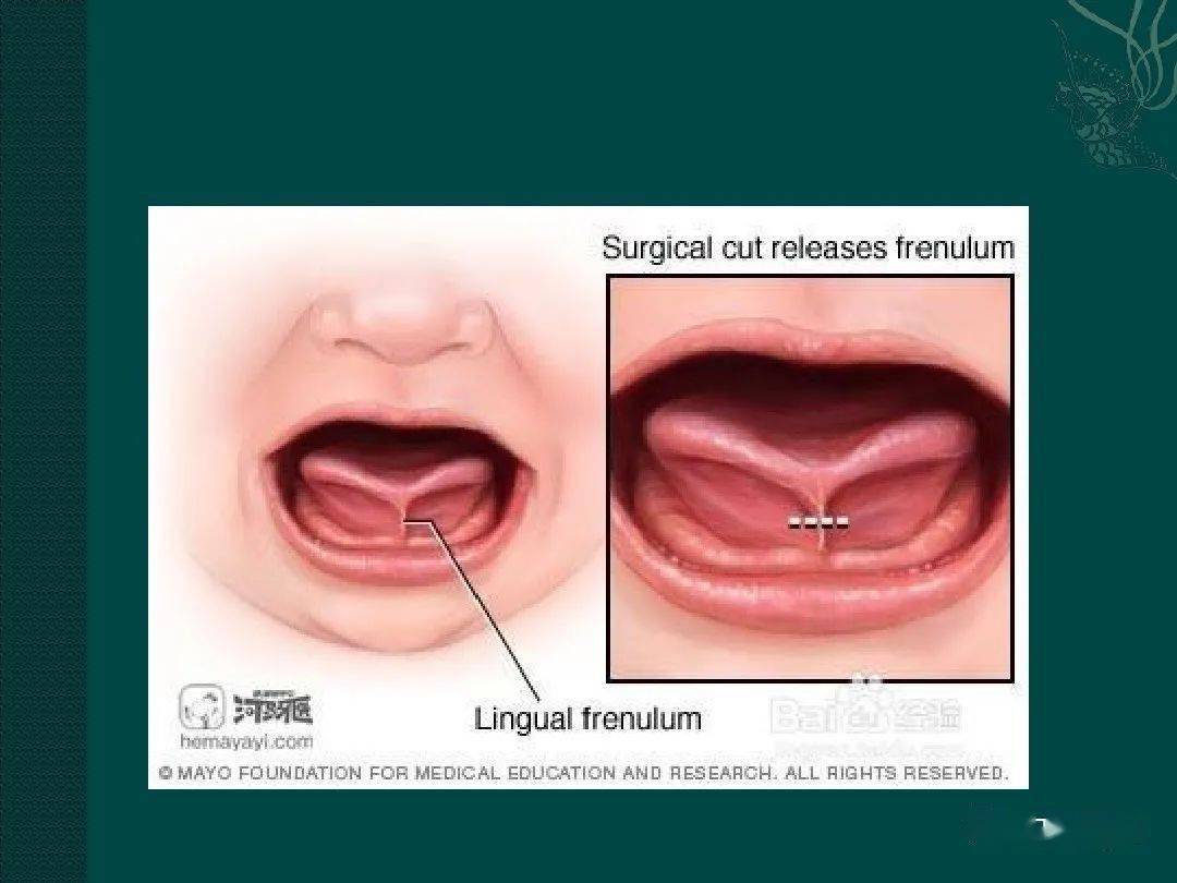 舌系带过短的诊断与治疗