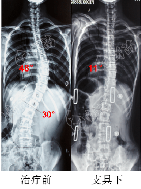 治疗过程(4)左右腰线不对称,左腰线凹陷(3)右剃刀背(2)肩胛骨不对称(1