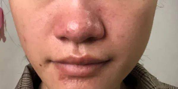 万年草莓鼻有救了!每天不到1块钱,米粒大的黑头连根拔起,又爽又恶心!