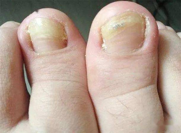 不瞒你说脚趾是癌症报警器出现3种症状已是癌症早期健康须知