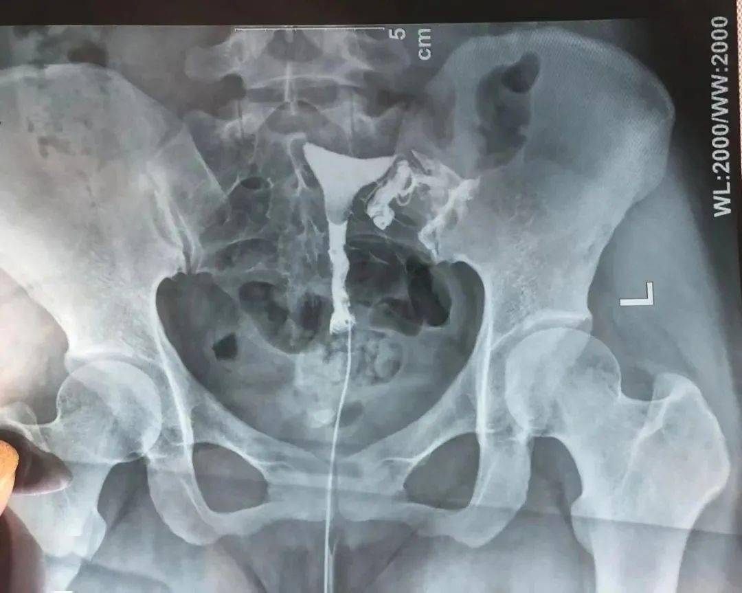 【女性不孕症】输卵管介入治疗术,圆您做母亲的梦想!