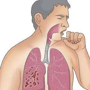 咳嗽久治不愈竟是气管上长了骨头