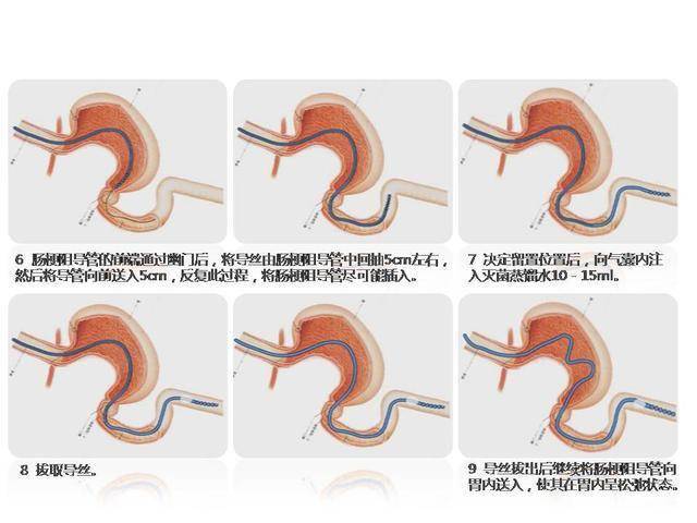 肠梗阻导管 工作原理图片