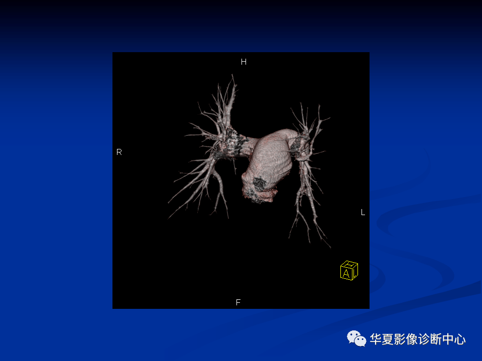 肺门残根征的图图片