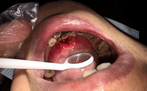 去除部分牙结石后暴露出口底部巨大的创伤性溃疡周师傅三天前口腔底部