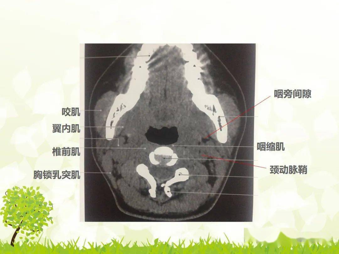 咽旁间隙解剖及常见病变影像表现