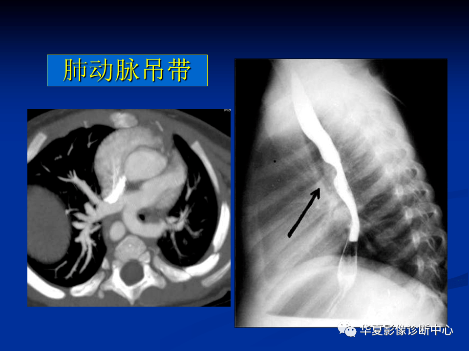 肺动脉常见病变的影像学表现