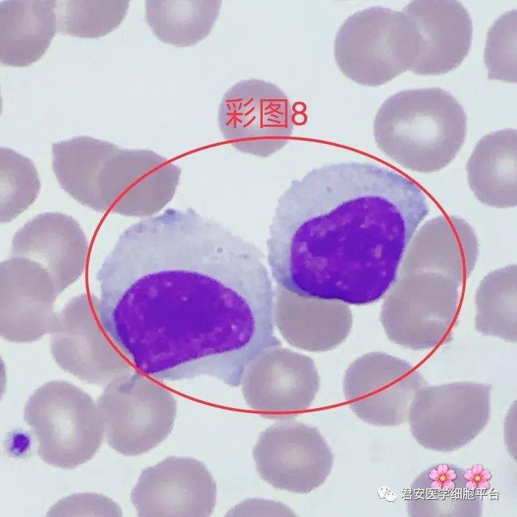 固缩成紫红色或紫黑色,副染色质不明显,胞质内见2个豪焦氏小体