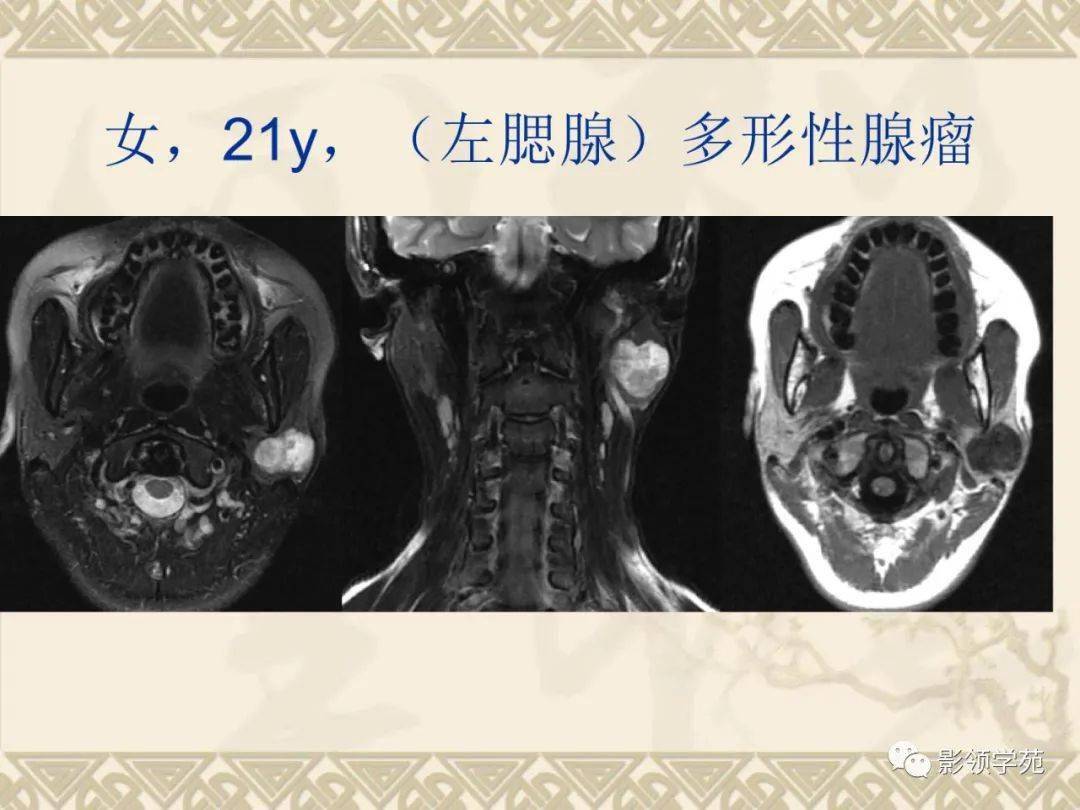 腮腺解剖及病变影像学表现