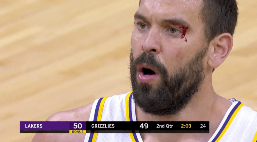 又伤了脸缝了4针詹姆斯秀logo三分逆转赢球