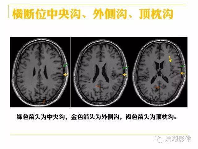 高清頭顱mr解剖圖譜_斷層