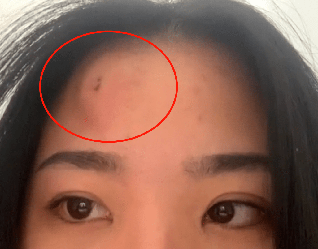 女主人的额头被门撞上后,立马肿起了个大包.