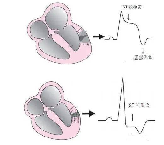 多見於早期成功再灌注(溶栓或pci),部分為血栓自溶或側支循環及時建立