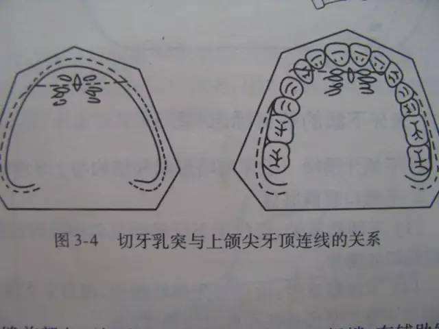 切牙乳突的位置图片