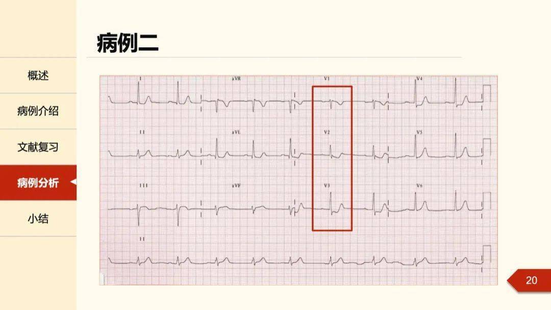 孔令秋教授正后壁心肌梗死的定位困惑及心电图线索