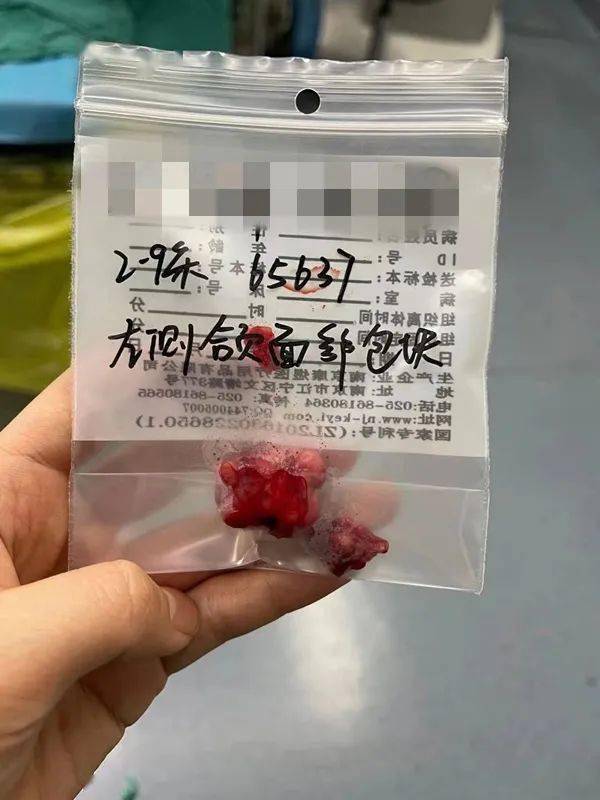 年輕警察遭遇腮腺腫瘤襲擊精準切除腫瘤免毀容