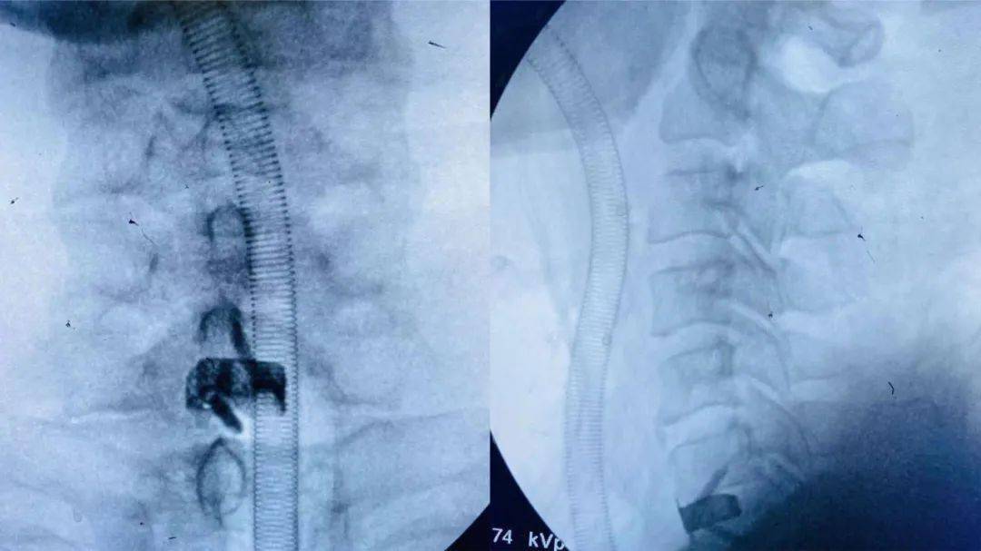 脊髓型颈椎病术中c型臂透视正,侧位片脊髓型颈椎病术后x线正,侧位片
