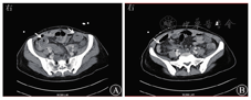 腹部和盆腔ct檢查示腹盆腔積液;小腸和結腸壁瀰漫性增厚;左側腎盂,輸
