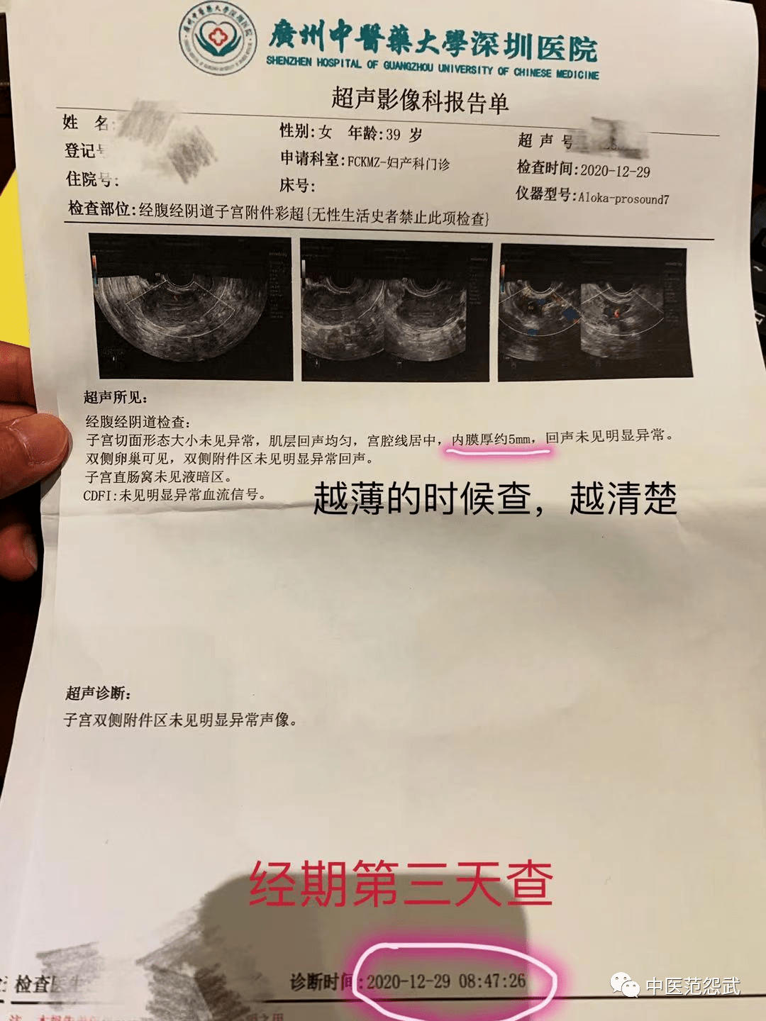 子宮內膜息肉一例_月經