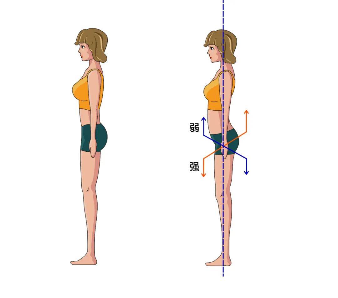 左到右:正常 | 骨盆前傾 | 骨盆後傾或者駝背等當然也可以使用貼牆