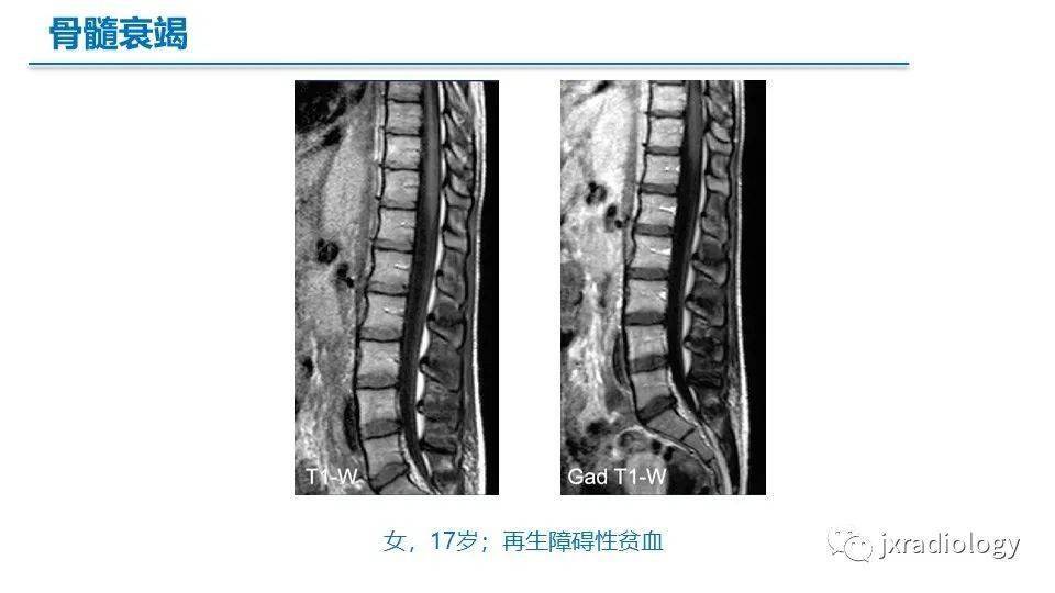 骨髓mr:红骨髓,黄骨髓和病变(mri of bone marrow:red, yellow and