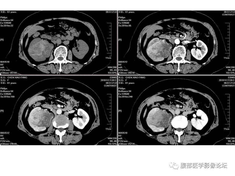 肾脏丨上皮样血管平滑肌脂肪瘤eaml