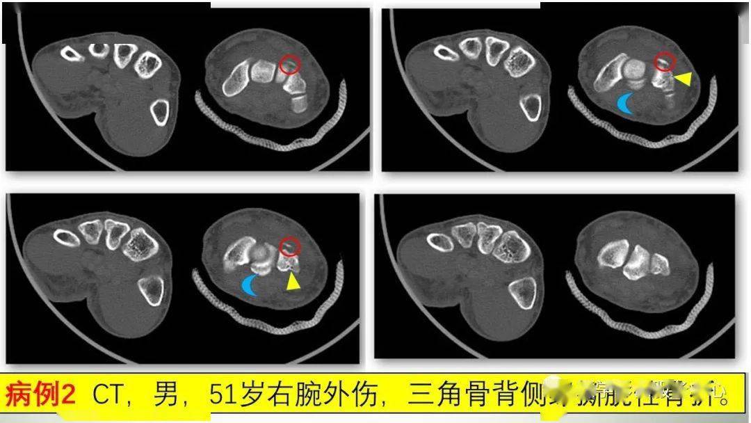病例2病例1:ct,男,42岁,左腕部外伤,三角骨背侧缘骨折.