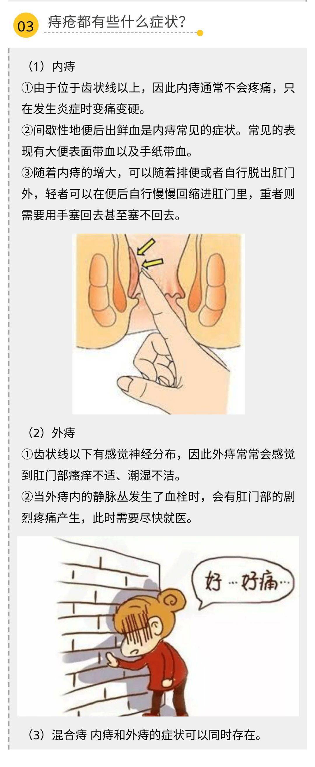 痔疮栓要塞多深图片