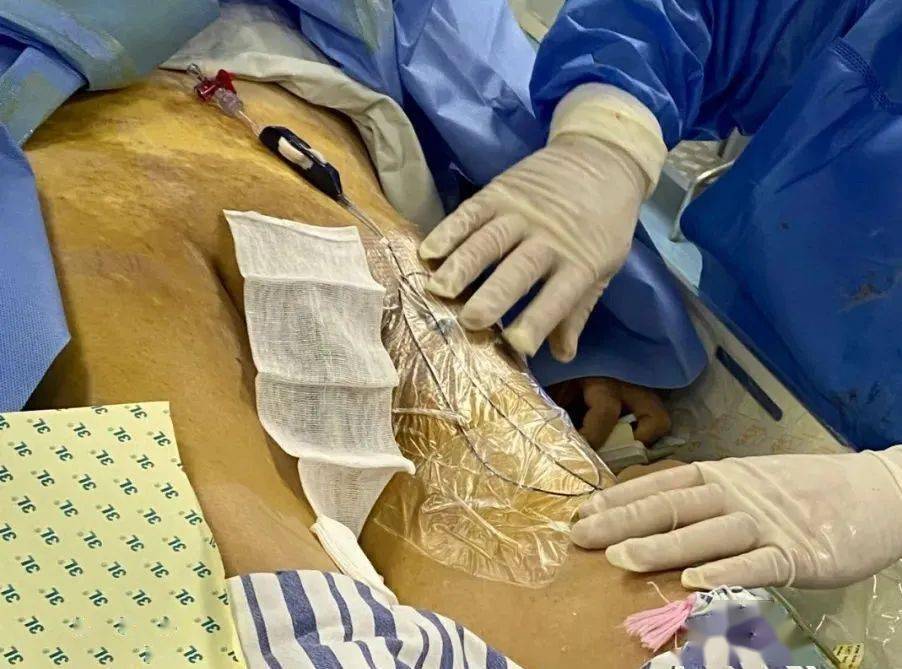 控微导管 | 联合d-tace   haic67为91岁肝癌骨转移老人成功介入手术