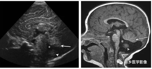 女孩,產前超聲顯示異常,產後mr證實第四腦室上部及小腦上蚓部相對正常