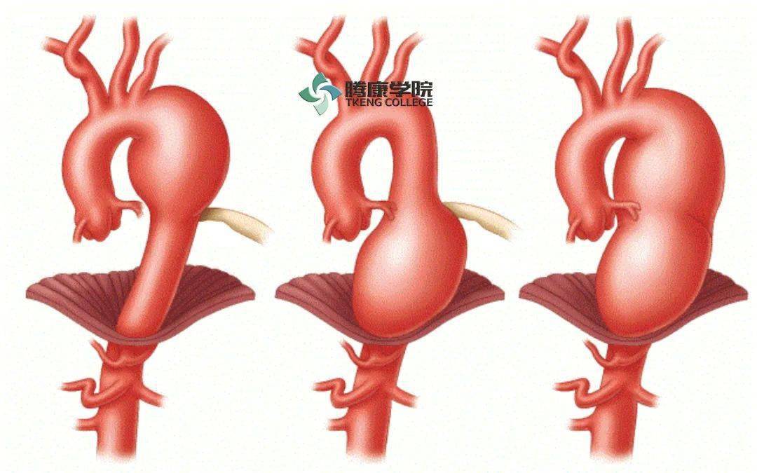 升主动脉瘤表现为前胸壁疼痛,放射至下颌,颈或咽喉部;降主动脉瘤表现