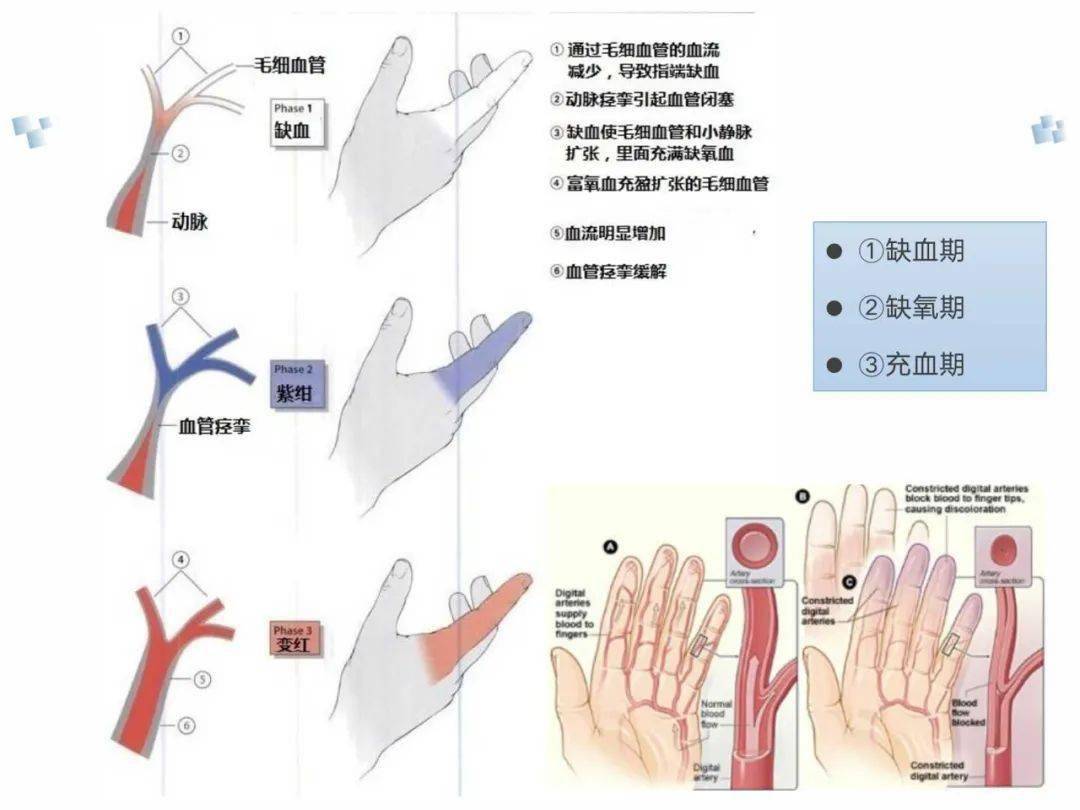 雷诺病PPT图片