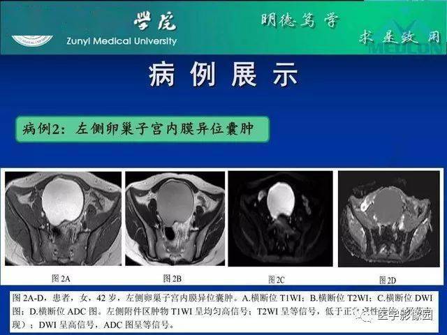 卵巢良性囊性病变的ct,mri表现