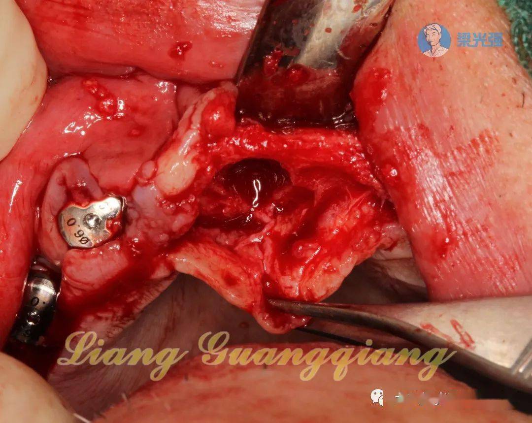牙医学堂全口种植切牙孔种植敲击内提
