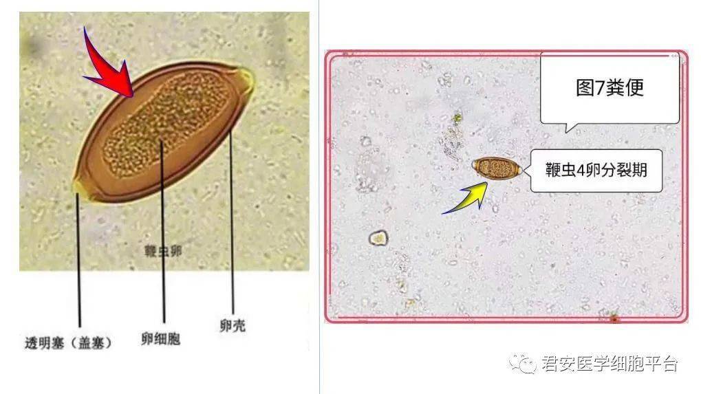鞭虫卵结构图图片