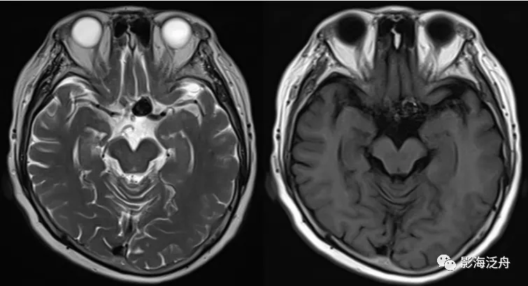 颅脑mr平扫中极易漏诊的点