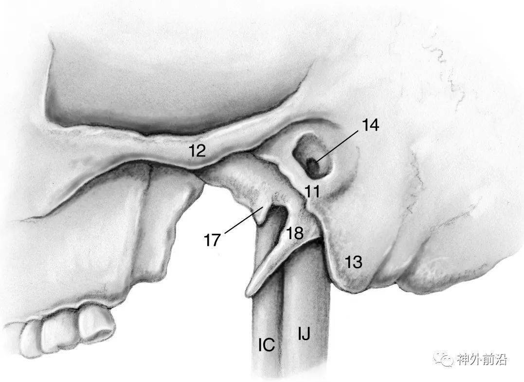 11 鼓板12 颧突13 乳突14 外耳道17 鼓室嵴18 茎突ic 颈内动脉ij 颈内