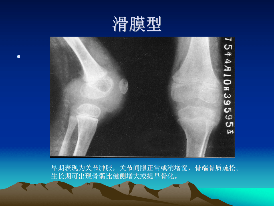 膝关节结核的影像学诊断