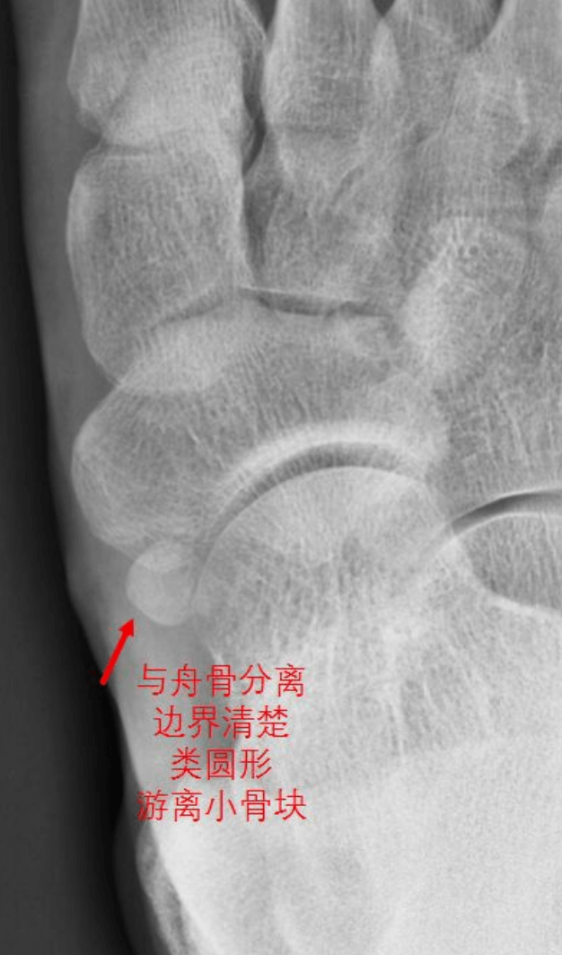 Ⅰ型:籽骨型01分型-lawson教授报道3种副舟骨型态解剖学和骨生物力学