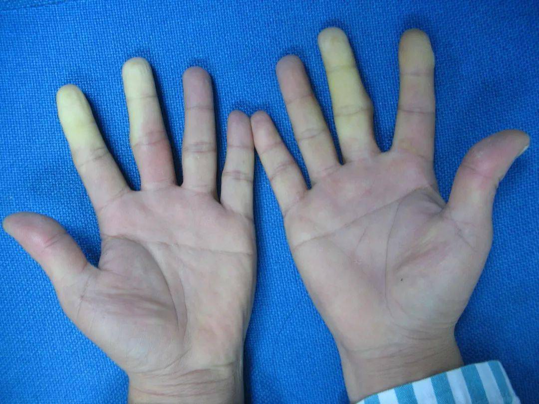 手臂振动病的诊断与防治