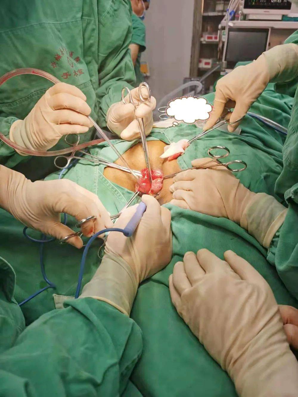 孙平良教授使用xnz肛肠微创四步疗法技术为患者进行微创手术xnz肛肠