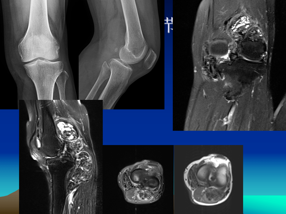 膝关节结核的影像学诊断