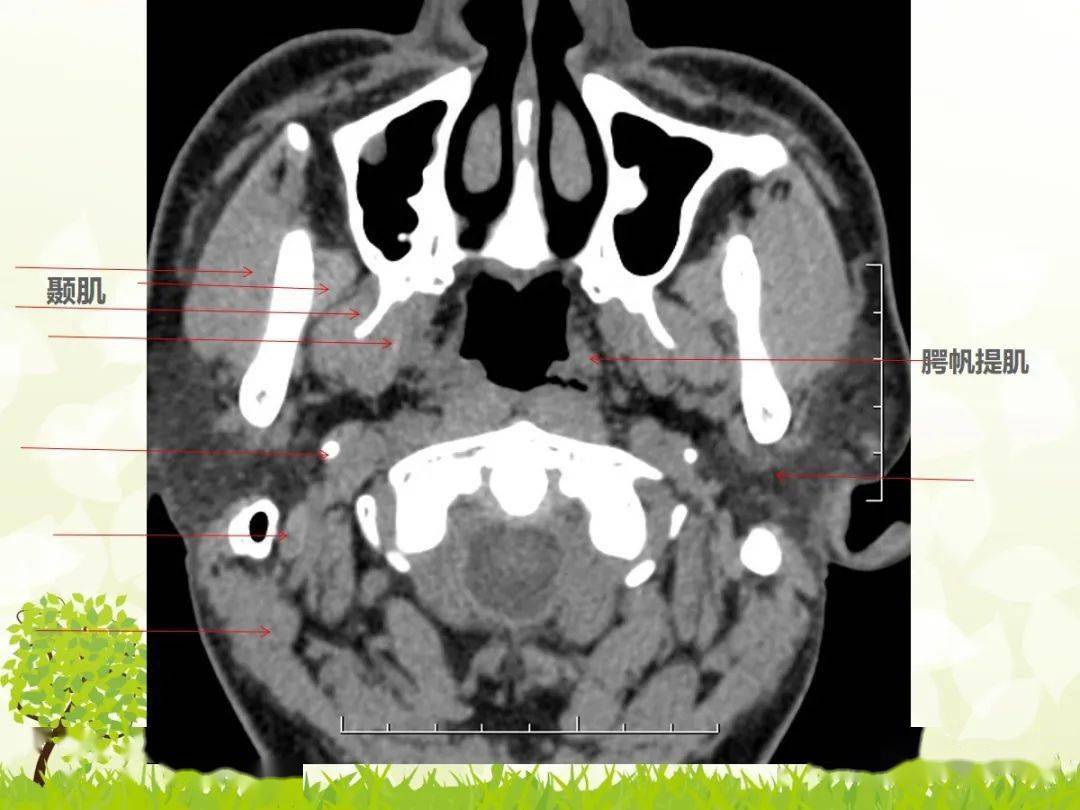 咽旁间隙解剖及常见病变影像表现